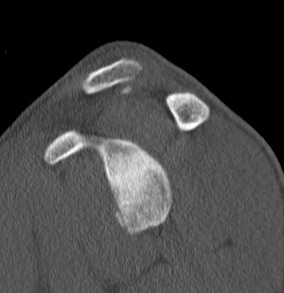 CT Sagittal Small Bony Bankart